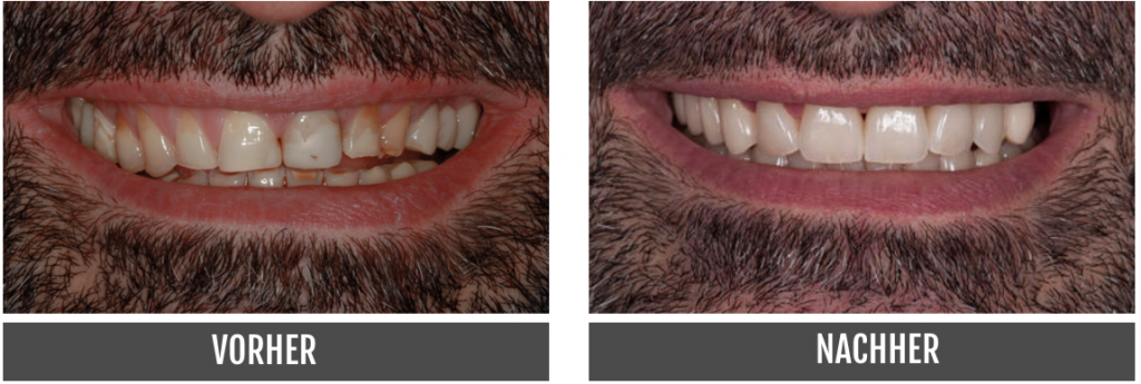 Veneers Vorher Nachher Zahntechniker Nürnberg