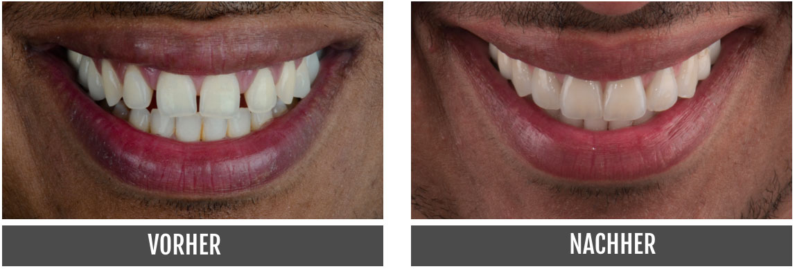 Non-Prep-Veneers Nürnberg Vorher Nachher - Dentallabor - Zahntechnik