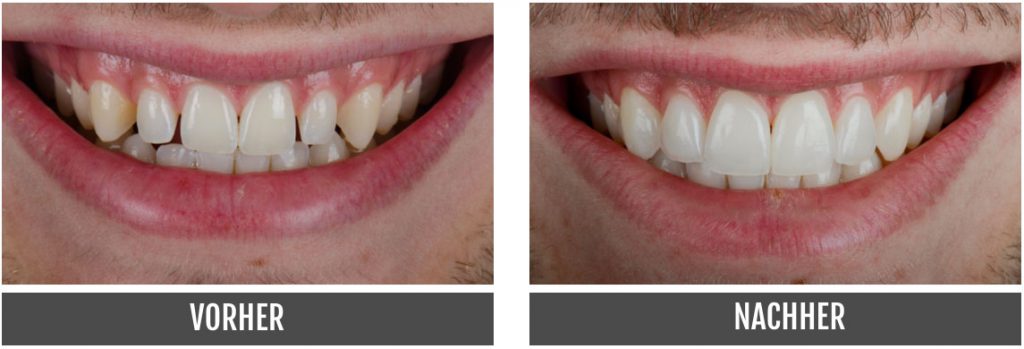 Vorher Nachher Veneers Nürnberg Dentallabor