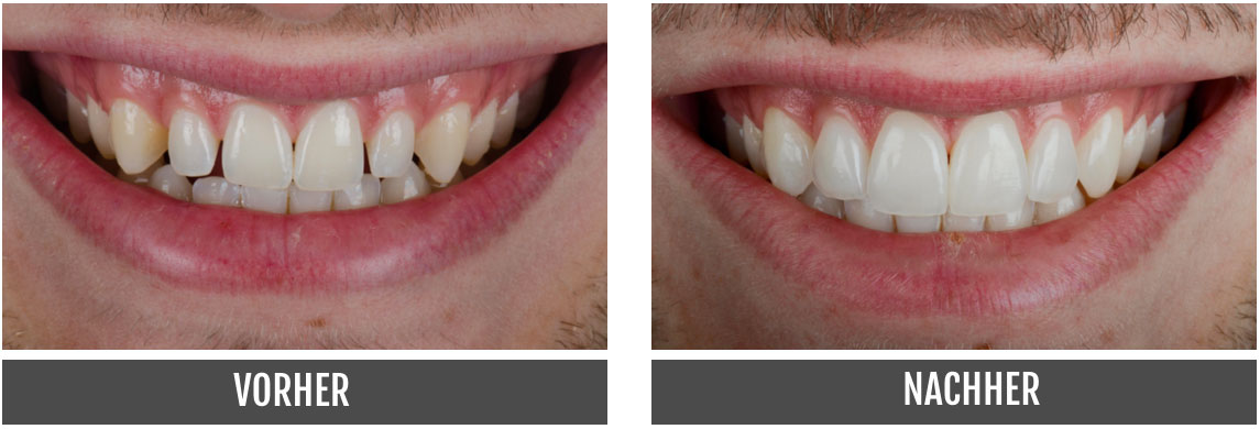 Vorher Nachher Veneers Nürnberg Dentallabor