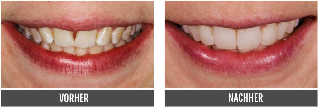 Veneers Vorher Nachher Zahnlabor Nürnberg