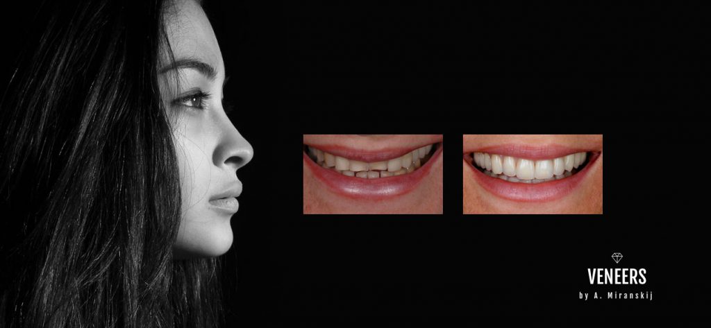 Veneers Dentallabor Nürnberg Vorher Nachher