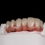 Zahn Implantat - Dentallabor Nürnberg - Zahnlabor Nürnberg - Dentalmanufaktur