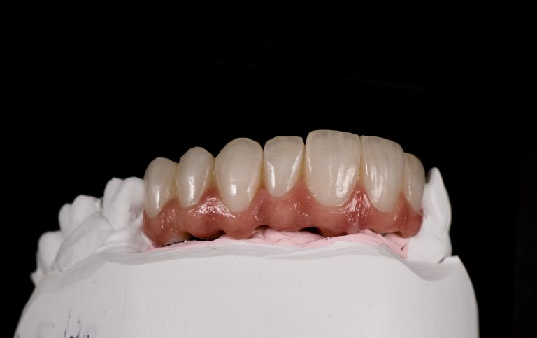 Zahn Implantat - Dentallabor Nürnberg - Zahnlabor Nürnberg - Dentalmanufaktur