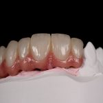 Zahn Implantat - Dentallabor Nürnberg - Zahnlabor Nürnberg - Dentalmanufaktur