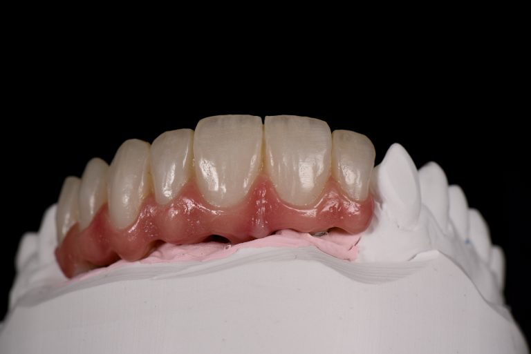 Zahn Implantat - Dentallabor Nürnberg - Zahnlabor Nürnberg - Dentalmanufaktur