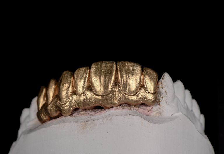 Zahn Implantat - Dentallabor Nürnberg - Zahnlabor Nürnberg - Dentalmanufaktur