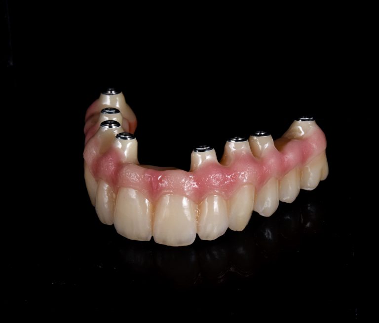 Zahn Implantat - Dentallabor Nürnberg - Zahnlabor Nürnberg - Dentalmanufaktur