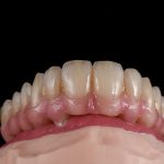 Zahn Implantat - Dentallabor Nürnberg - Zahnlabor Nürnberg - Dentalmanufaktur