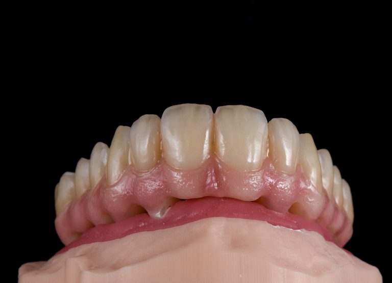 Zahn Implantat - Dentallabor Nürnberg - Zahnlabor Nürnberg - Dentalmanufaktur