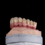 Zahn Implantat - Dentallabor Nürnberg - Zahnlabor Nürnberg - Dentalmanufaktur