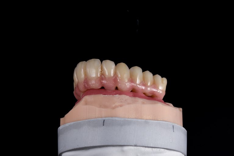 Zahn Implantat - Dentallabor Nürnberg - Zahnlabor Nürnberg - Dentalmanufaktur