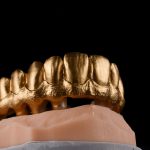 Zahn Implantat - Dentallabor Nürnberg - Zahnlabor Nürnberg - Dentalmanufaktur