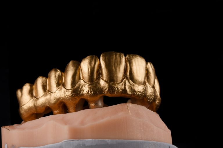 Zahn Implantat - Dentallabor Nürnberg - Zahnlabor Nürnberg - Dentalmanufaktur