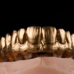 Zahn Implantat - Dentallabor Nürnberg - Zahnlabor Nürnberg - Dentalmanufaktur