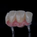 Zahn Implantat - Dentallabor Nürnberg - Zahnlabor Nürnberg - Dentalmanufaktur