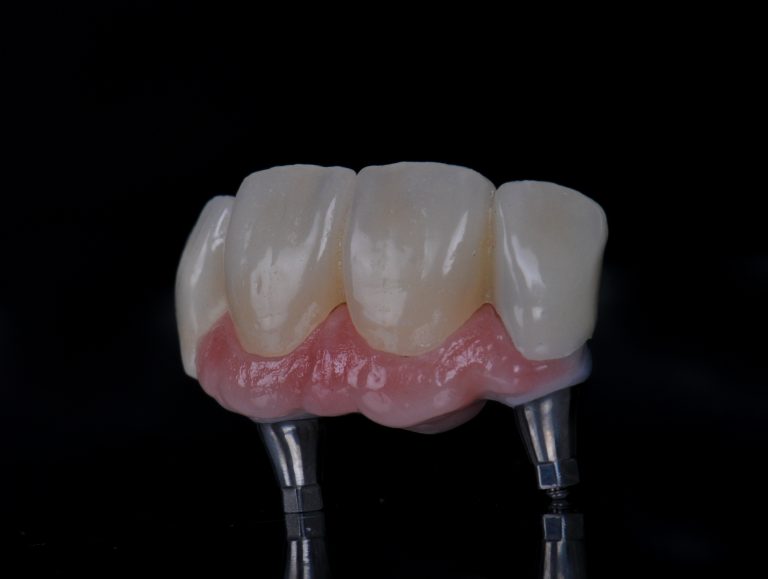 Zahn Implantat - Dentallabor Nürnberg - Zahnlabor Nürnberg - Dentalmanufaktur