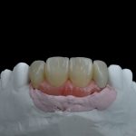 Zahn Implantat - Dentallabor Nürnberg - Zahnlabor Nürnberg - Dentalmanufaktur