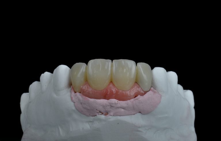 Zahn Implantat - Dentallabor Nürnberg - Zahnlabor Nürnberg - Dentalmanufaktur