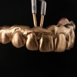 Zahn Implantat - Dentallabor Nürnberg - Zahnlabor Nürnberg - Dentalmanufaktur