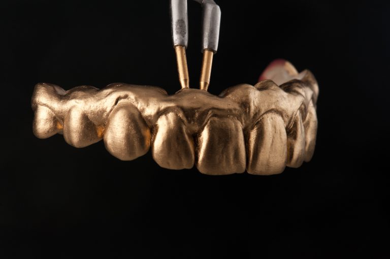 Zahn Implantat - Dentallabor Nürnberg - Zahnlabor Nürnberg - Dentalmanufaktur