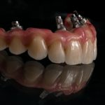 Zahn Implantat - Dentallabor Nürnberg - Zahnlabor Nürnberg - Dentalmanufaktur