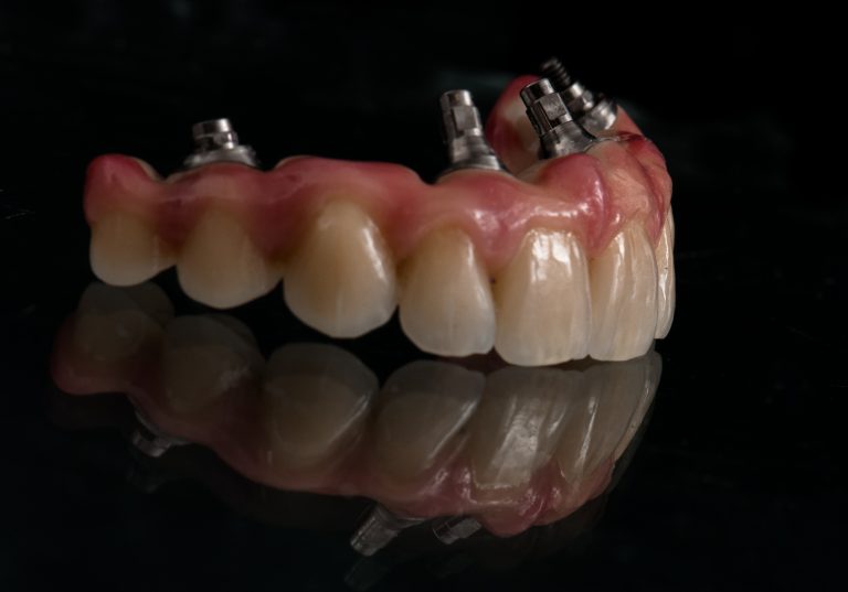 Zahn Implantat - Dentallabor Nürnberg - Zahnlabor Nürnberg - Dentalmanufaktur