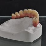 Zahn Implantat - Dentallabor Nürnberg - Zahnlabor Nürnberg - Dentalmanufaktur