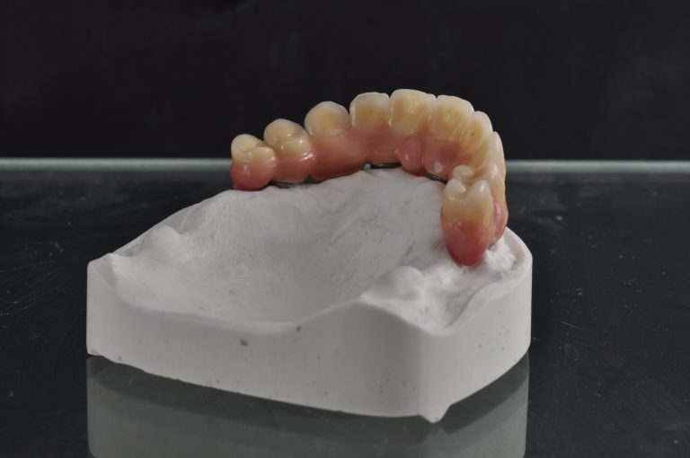 Zahn Implantat - Dentallabor Nürnberg - Zahnlabor Nürnberg - Dentalmanufaktur