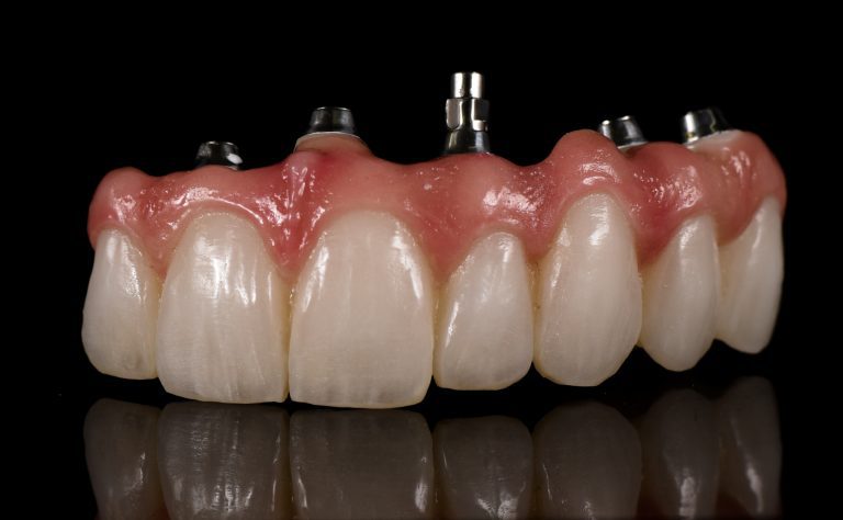 Zahn Implantat - Dentallabor Nürnberg - Zahnlabor Nürnberg - Dentalmanufaktur