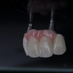 Zahn Implantat - Dentallabor Nürnberg - Zahnlabor Nürnberg - Dentalmanufaktur