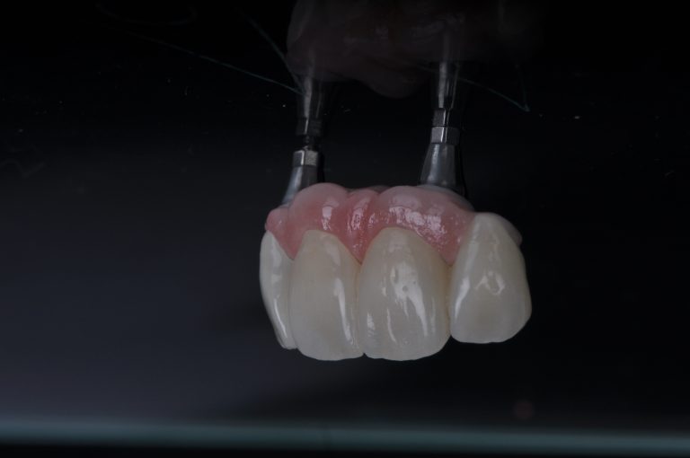 Zahn Implantat - Dentallabor Nürnberg - Zahnlabor Nürnberg - Dentalmanufaktur