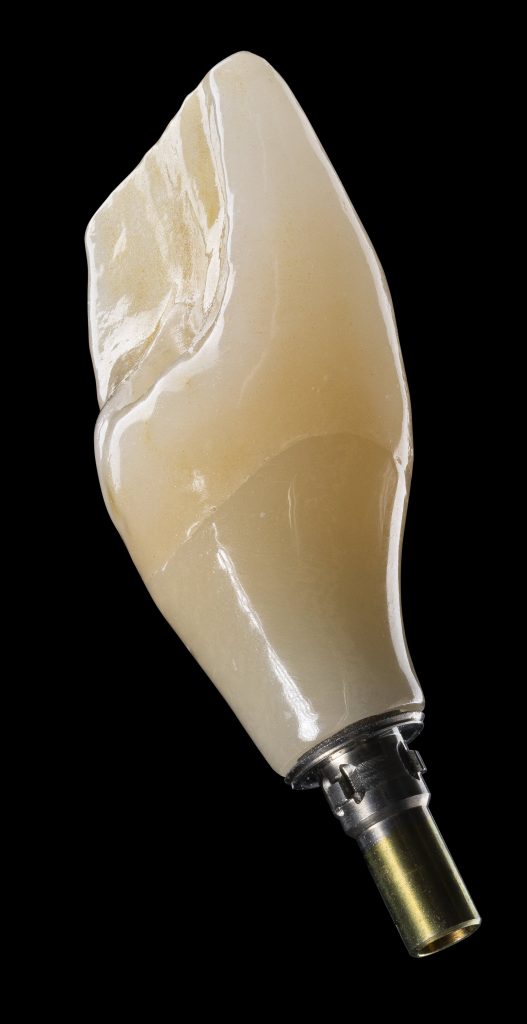 Implantat - Zahnlabor - Dentallabor - Nürnberg Dentalmanufaktur