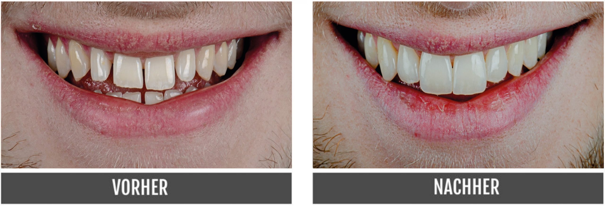 Non-Prep-Veneers - Vorher Nachher - Nürnberg - Dentallabor - Zahntechnik - Zahnlabor