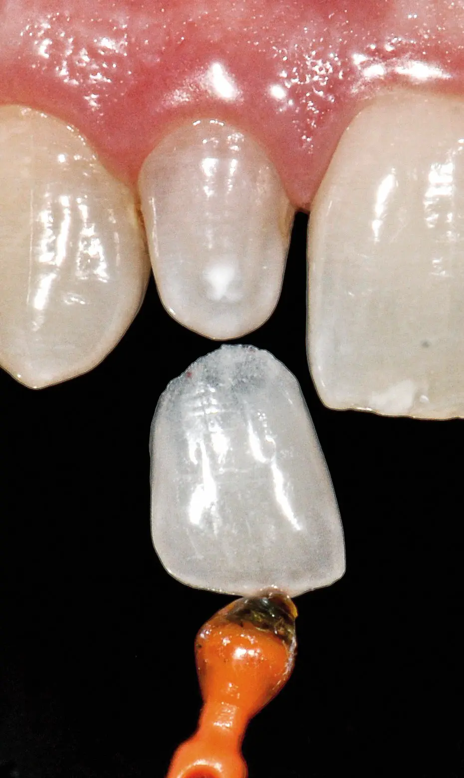 Non-Prep-Veneers - schiefe Zähne richten Erwachsene - ohne Zahnspange Non-Prep-Veneers - schiefe Zähne richten Erwachsene - ohne Zahnspange