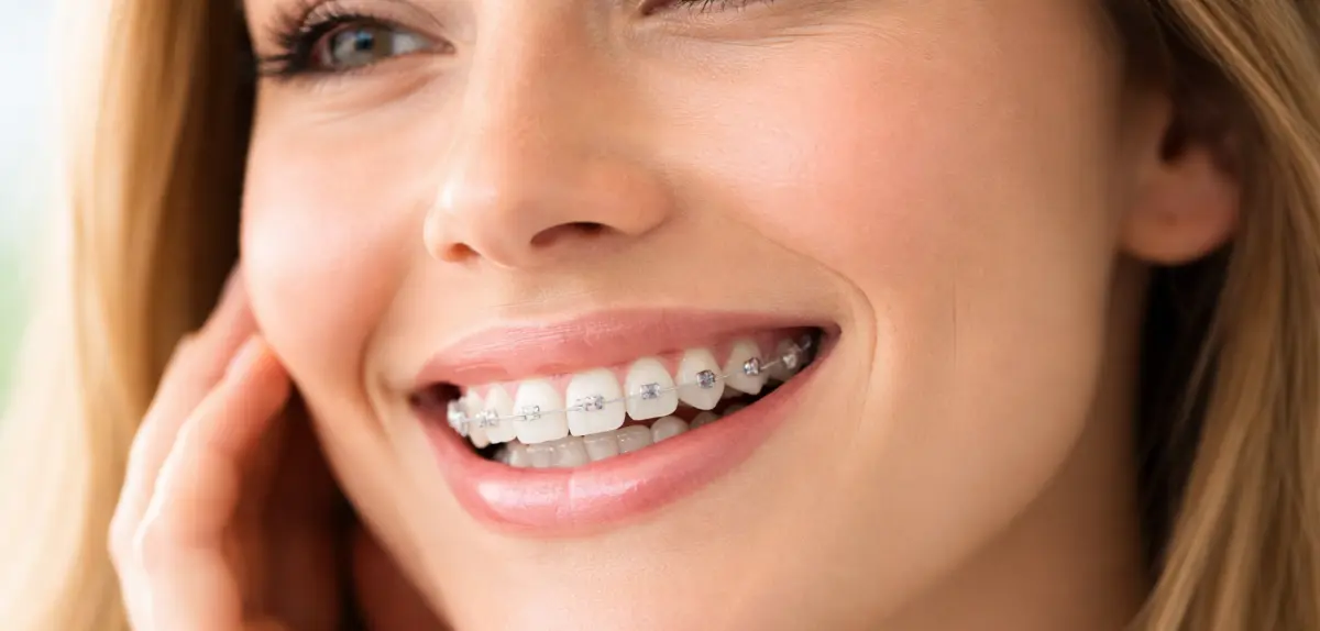 Schiefe Zähne richten lassen - Kieferorthopädie Schiefe Zähne richten lassen - Kieferorthopädie