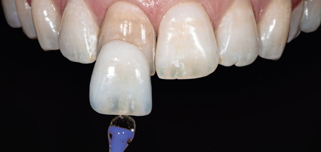 Veneers Nürnberg - Dentallabor - Zahnersatz - Zahnlabor Nürnberg