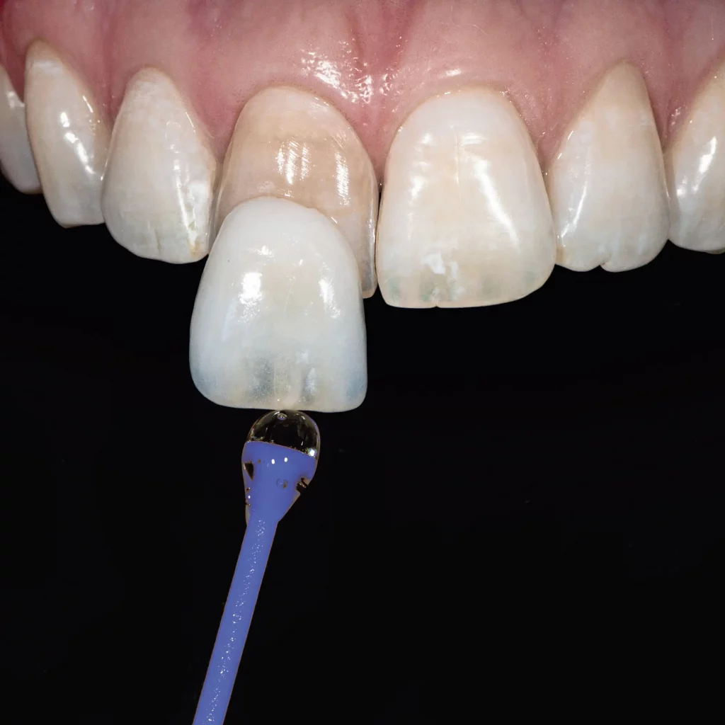 Veneers Nürnberg - Veneers individuell gestalten