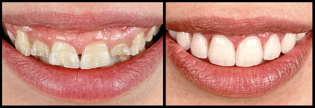 Veneers Nürnberg - Veneers sehen natürlich aus