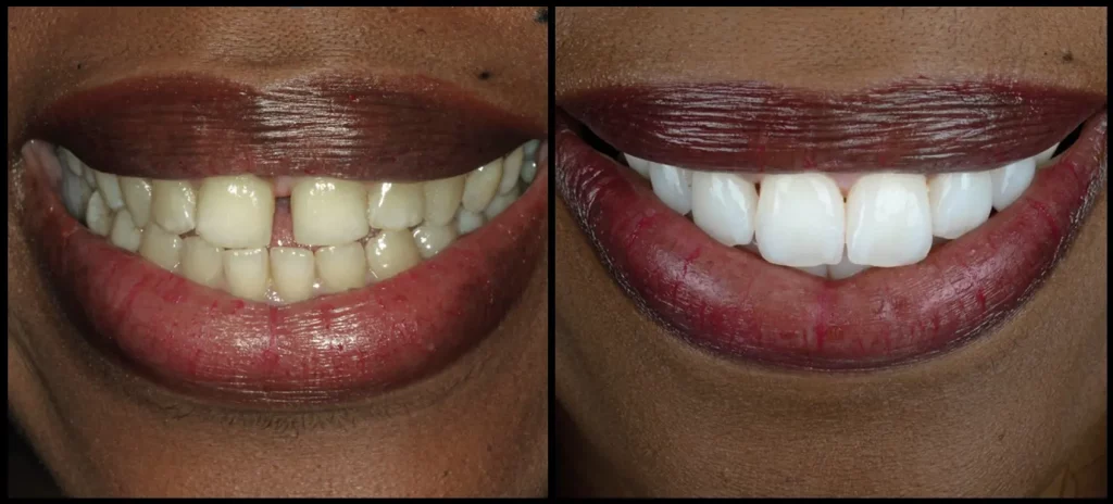 Veneers bei schiefen Zähnen und Zahnlücken